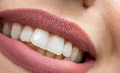 Primer plano de una sonrisa con los dientes alineados y blancos