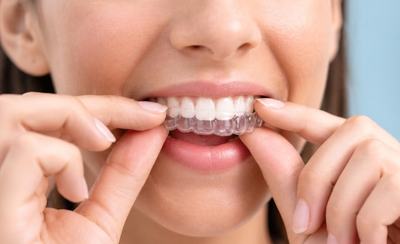 Paciente colocándose un alineador dental transparente