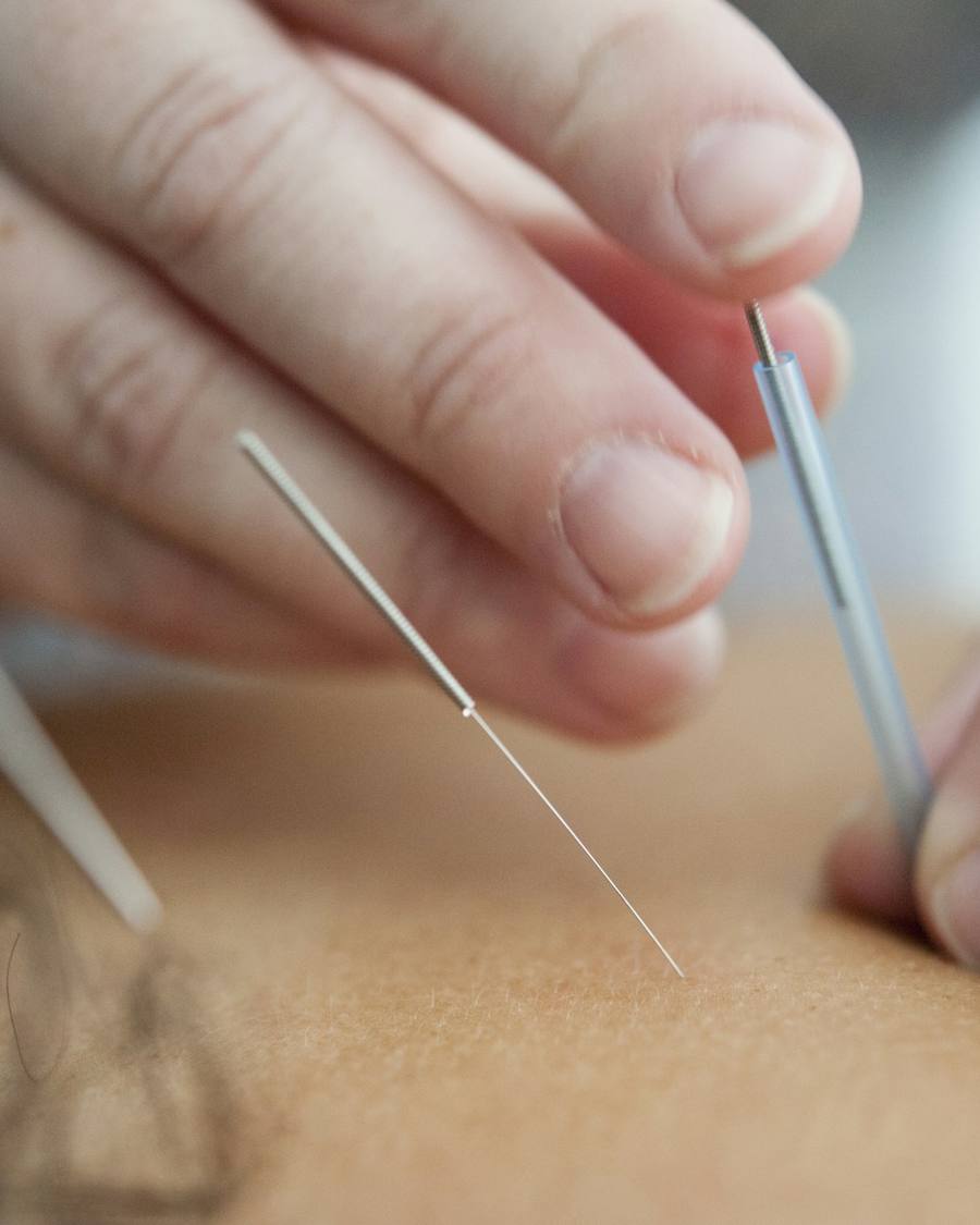 Manos de un fisioterapeuta colocando una aguja fina sobre la piel.